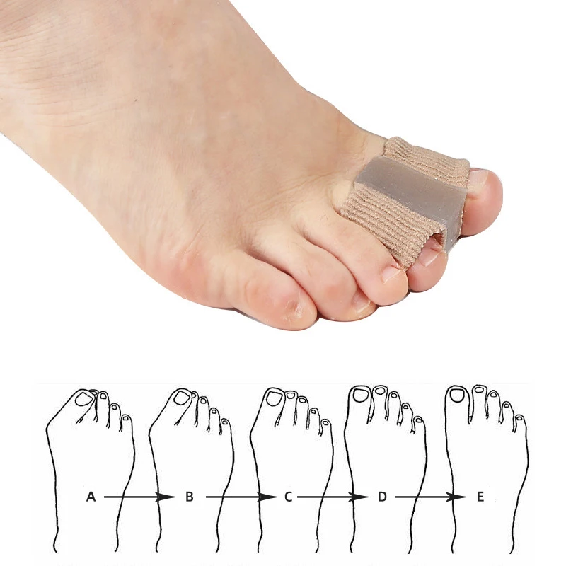 Novo Separador de Dedos, Corre - Toe Separator Silicon avaliação e preço